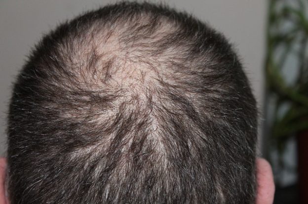 A Greffe de cheveux en Hongrie kezelései kifinomultak